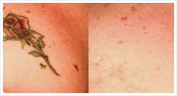 Everything You Need To Know About Laser Tattoo Removal
