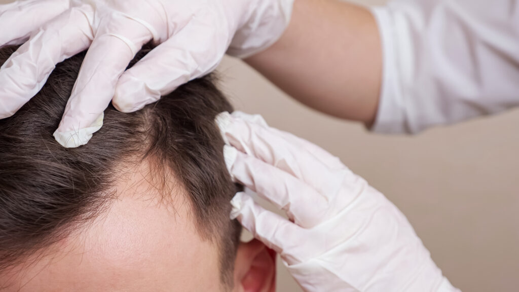 PRP injections for hair loss are shown to reverse the effects of low follicle growth, leading to a fuller, healthier head of hair.