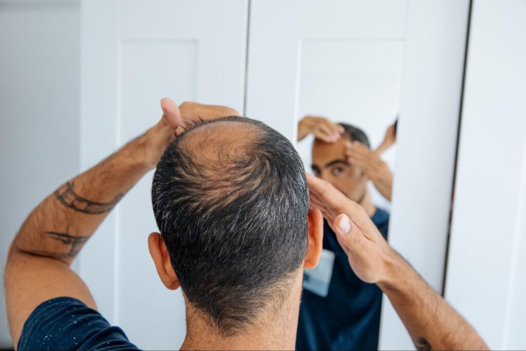 Hair Loss Solutions for Men & Women