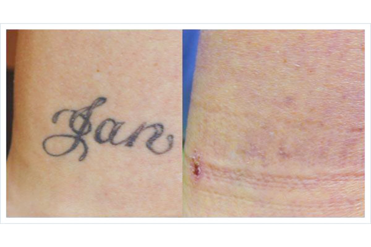 Everything You Need to Know About Tattoo Removal