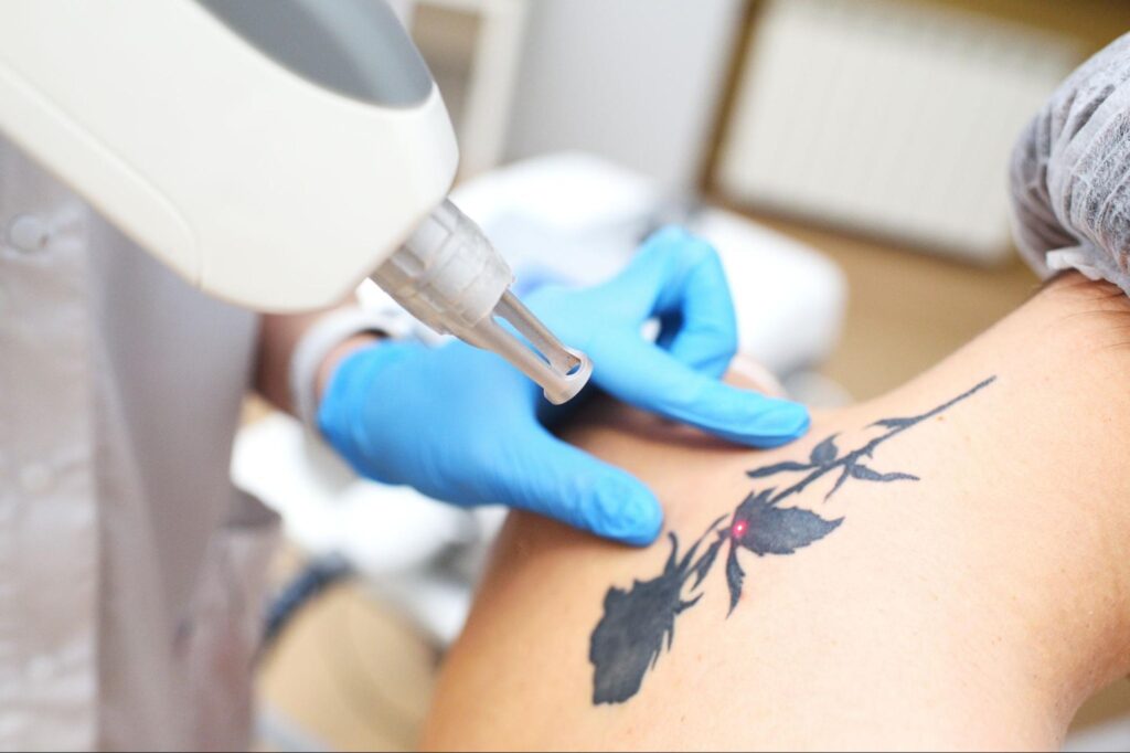 Laser Skin Treatments for Unwanted Tattoo Removal