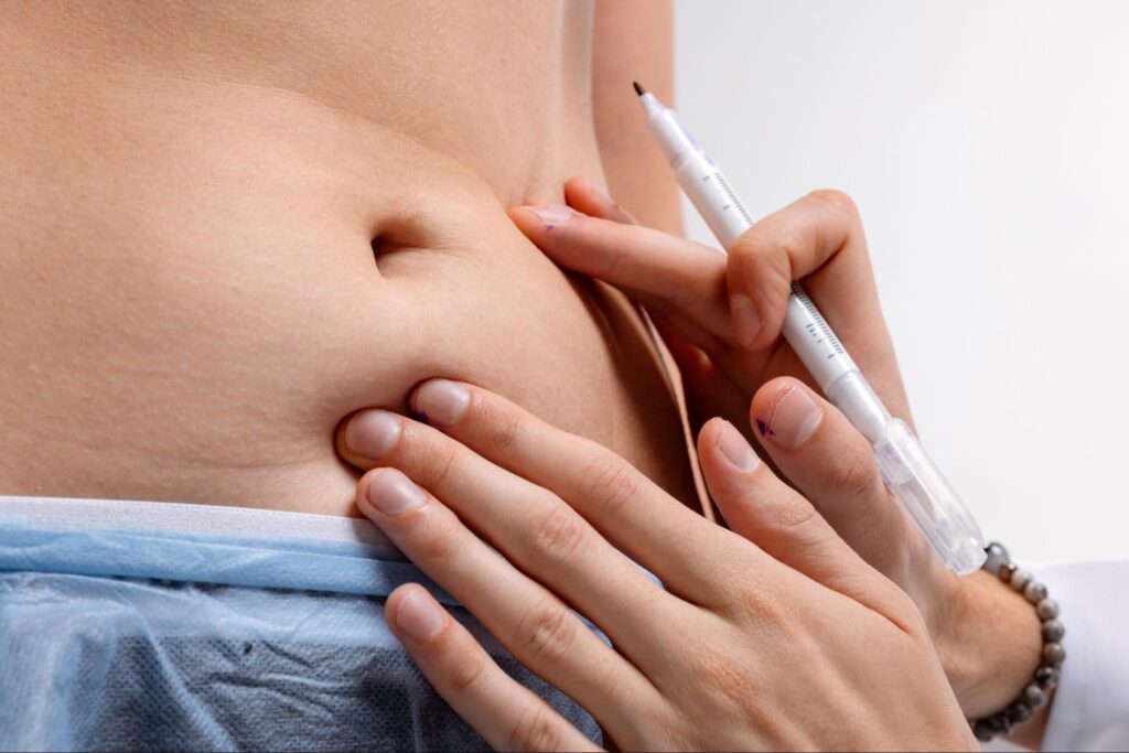 What To Expect From Liposuction in Memphis