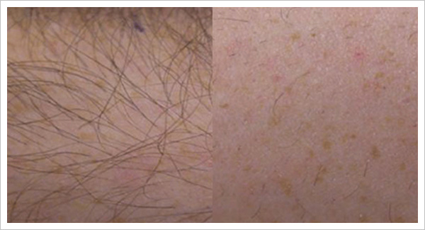 laser hair removal before and after
