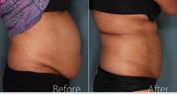 All About VASER Liposuction