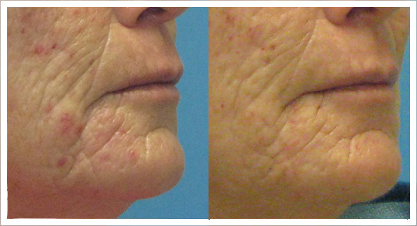 Micro laser peel before and after