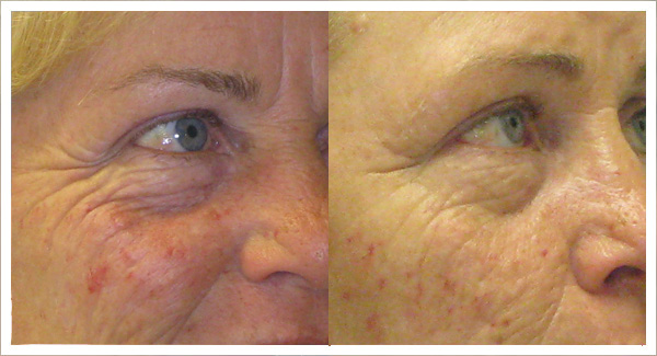 Micro laser peel before and after