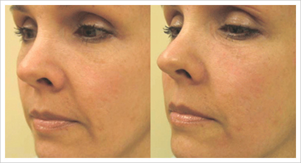 skin tightening before and after