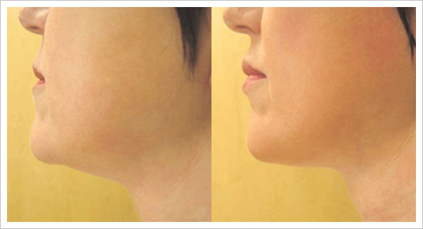 skin tightening before and after