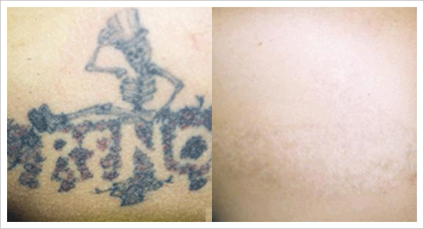 tattoo removal before and after